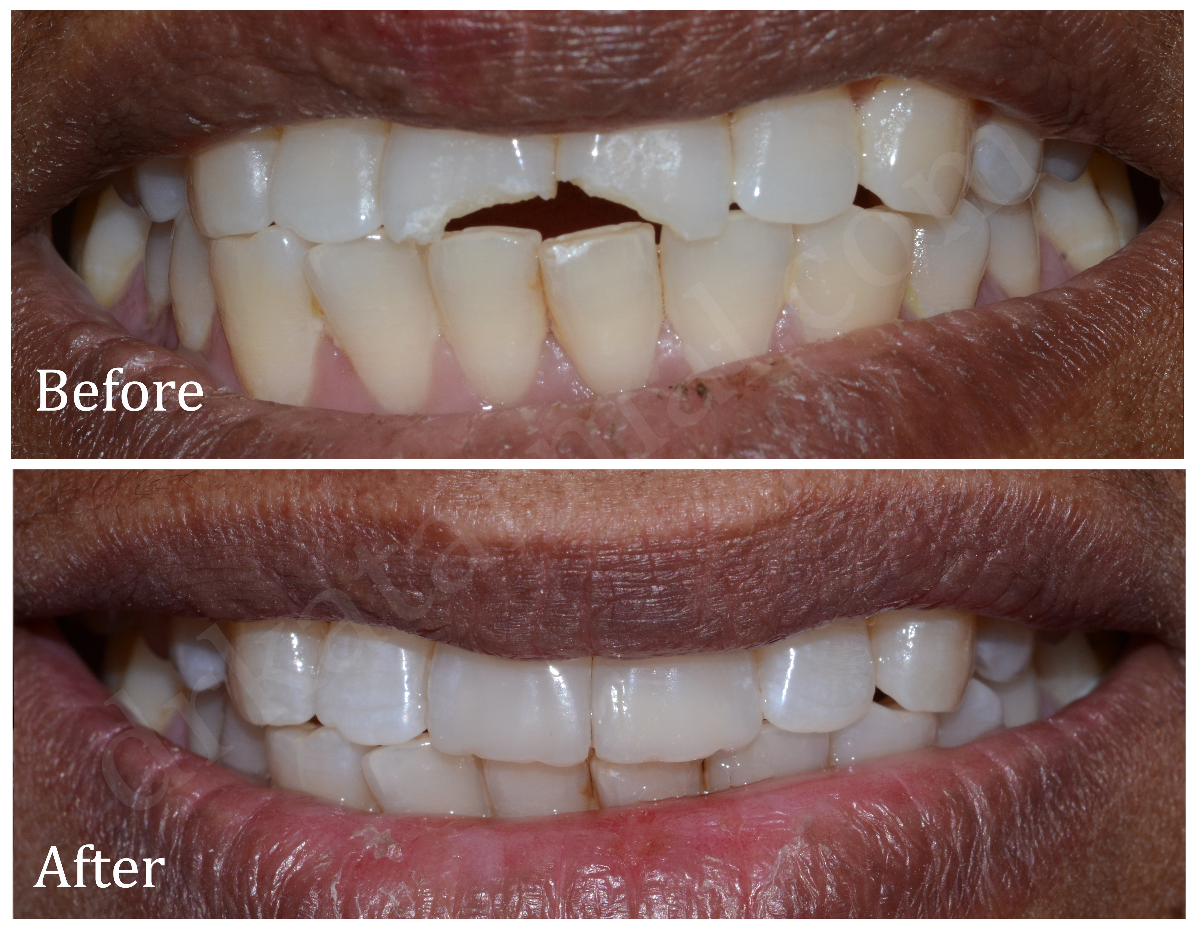 Broken Front Teeth Repair with Composit ~ Dr. Bharat Katarmal
